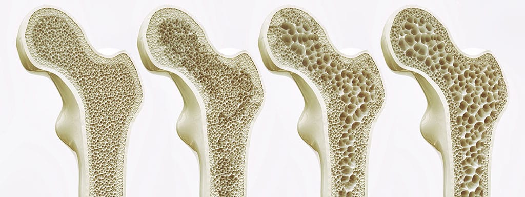 Kmenové buňky napomáhají růstu kostí a chrupavek. Na snímku čtyři stádia osteoporózy.