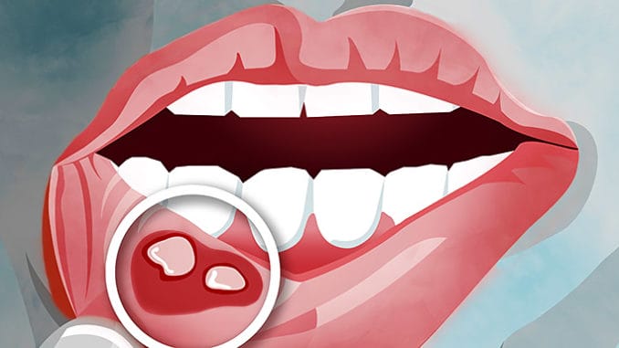 Opary, afty a popraskané koutky - jak je vyléčit?